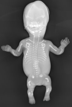 skeletal_dysplasia